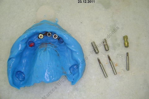 3 Implantes Imediatos na Maxila + Remoção de Cisto Apical - Parte Ii - Fase Protética