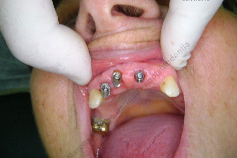 3 Implantes Imediatos na Maxila + Remoção de Cisto Apical - Parte Ii - Fase Protética