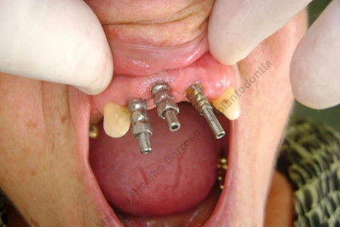 3 Implantes Imediatos na Maxila + Remoção de Cisto Apical - Parte Ii - Fase Protética