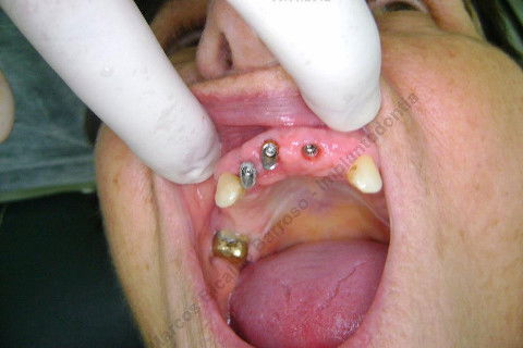 3 Implantes Imediatos na Maxila + Remoção de Cisto Apical - Parte Ii - Fase Protética