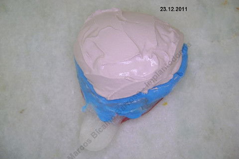 3 Implantes Imediatos na Maxila + Remoção de Cisto Apical - Parte Ii - Fase Protética