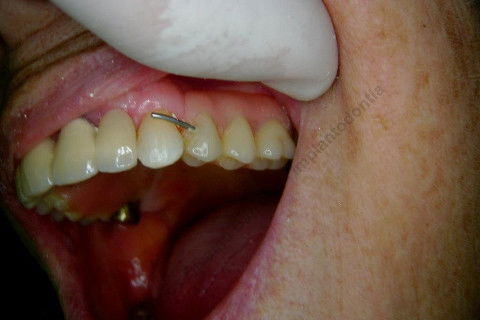 3 Implantes Imediatos na Maxila + Remoção de Cisto Apical - Parte Ii - Fase Protética