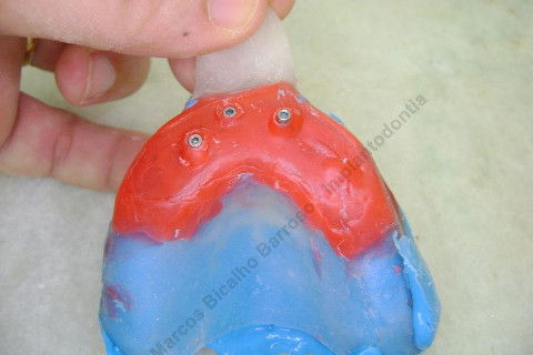 3 Implantes Imediatos na Maxila + Remoção de Cisto Apical - Parte Ii - Fase Protética