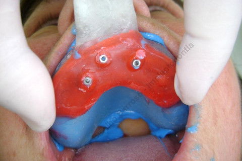 3 Implantes Imediatos na Maxila + Remoção de Cisto Apical - Parte Ii - Fase Protética