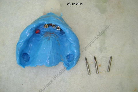 3 Implantes Imediatos na Maxila + Remoção de Cisto Apical - Parte Ii - Fase Protética