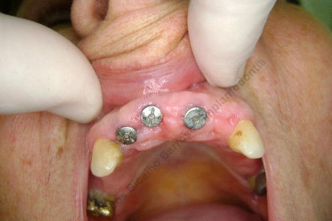 3 Implantes Imediatos na Maxila + Remoção de Cisto Apical - Parte Ii - Fase Protética