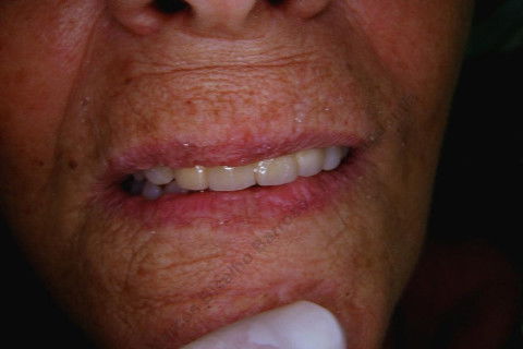 3 Implantes Imediatos na Maxila + Remoção de Cisto Apical - Parte Ii - Fase Protética