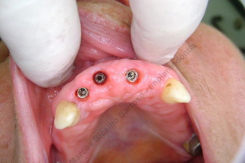 3 Implantes Imediatos na Maxila + Remoção de Cisto Apical - Parte Ii - Fase Protética