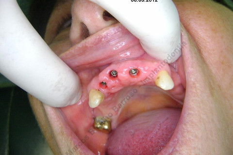 3 Implantes Imediatos na Maxila + Remoção de Cisto Apical - Parte Ii - Fase Protética