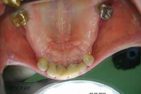 3 Implantes Imediatos na Maxila + Remoção de Cisto Apical - Parte Ii - Fase Protética
