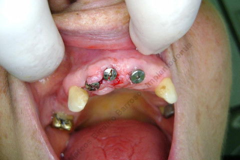 3 Implantes Imediatos na Maxila + Remoção de Cisto Apical - Parte Ii - Fase Protética