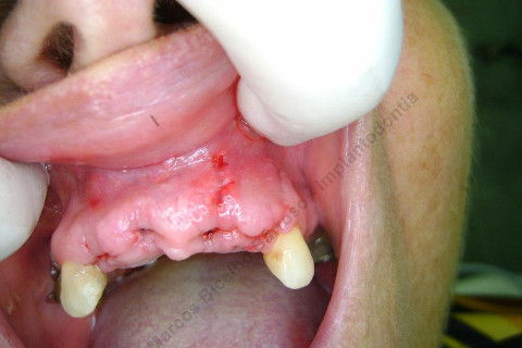3 Implantes Imediatos na Maxila + Remoção de Cisto Apical - Parte Ii - Fase Protética