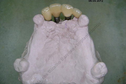 3 Implantes Imediatos na Maxila + Remoção de Cisto Apical - Parte Ii - Fase Protética