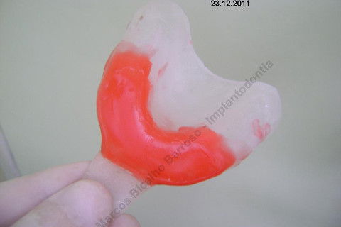 3 Implantes Imediatos na Maxila + Remoção de Cisto Apical - Parte Ii - Fase Protética