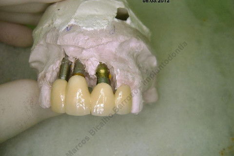 3 Implantes Imediatos na Maxila + Remoção de Cisto Apical - Parte Ii - Fase Protética