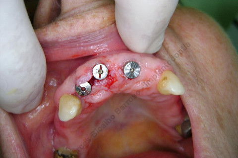 3 Implantes Imediatos na Maxila + Remoção de Cisto Apical - Parte Ii - Fase Protética