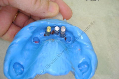 3 Implantes Imediatos na Maxila + Remoção de Cisto Apical - Parte Ii - Fase Protética