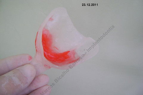 3 Implantes Imediatos na Maxila + Remoção de Cisto Apical - Parte Ii - Fase Protética