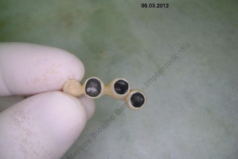 3 Implantes Imediatos na Maxila + Remoção de Cisto Apical - Parte Ii - Fase Protética