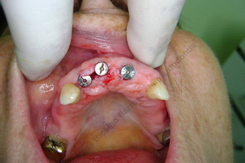 3 Implantes Imediatos na Maxila + Remoção de Cisto Apical - Parte Ii - Fase Protética