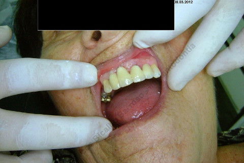 3 Implantes Imediatos na Maxila + Remoção de Cisto Apical - Parte Ii - Fase Protética