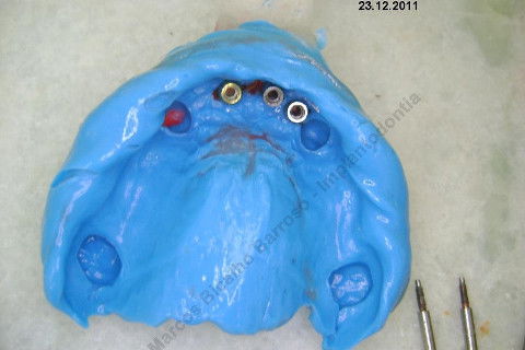 3 Implantes Imediatos na Maxila + Remoção de Cisto Apical - Parte Ii - Fase Protética