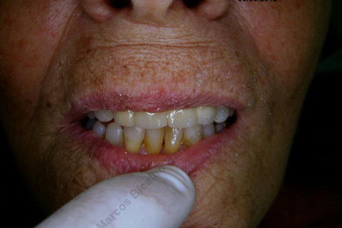 3 Implantes Imediatos na Maxila + Remoção de Cisto Apical - Parte Ii - Fase Protética