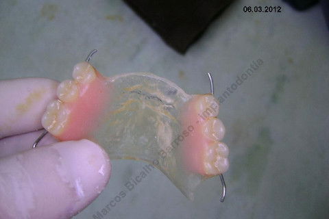 3 Implantes Imediatos na Maxila + Remoção de Cisto Apical - Parte Ii - Fase Protética