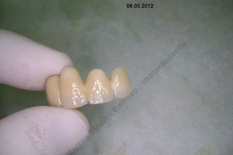 3 Implantes Imediatos na Maxila + Remoção de Cisto Apical - Parte Ii - Fase Protética