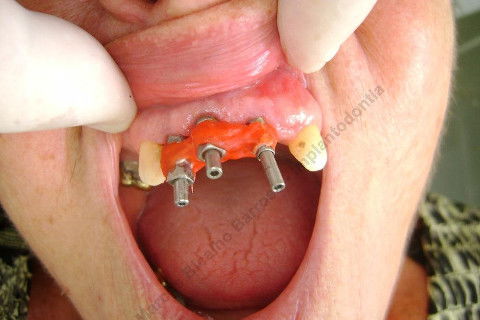 3 Implantes Imediatos na Maxila + Remoção de Cisto Apical - Parte Ii - Fase Protética