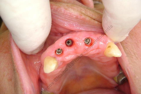 3 Implantes Imediatos na Maxila + Remoção de Cisto Apical - Parte Ii - Fase Protética
