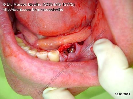 6 Implantes He na Mandíbula - Algumas Intercorrências - Parte I - Fase Cirúrgica