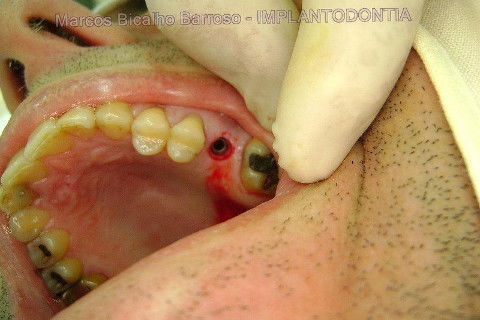 Implante Alvim Cone Morse - Instalação em 20 Minutos, Sem Retalho, Sem Sutura