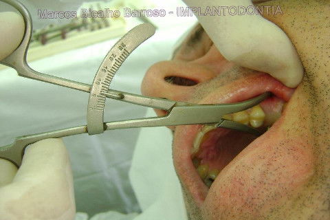 Implante Alvim Cone Morse - Instalação em 20 Minutos, Sem Retalho, Sem Sutura