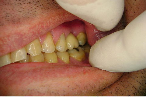 Implante Alvim Cone Morse - Instalação em 20 Minutos, Sem Retalho, Sem Sutura