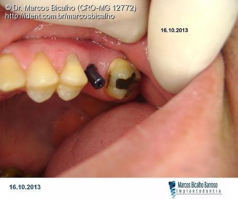Implante Alvim Cone Morse - Instalação em 20 Minutos, Sem Retalho, Sem Sutura