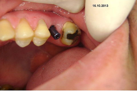 Implante Alvim Cone Morse - Instalação em 20 Minutos, Sem Retalho, Sem Sutura