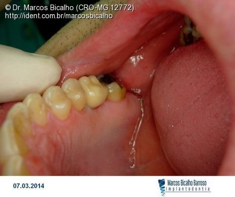 Implante Alvim Cone Morse - Instalação em 20 Minutos, Sem Retalho, Sem Sutura