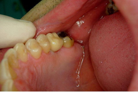 Implante Alvim Cone Morse - Instalação em 20 Minutos, Sem Retalho, Sem Sutura