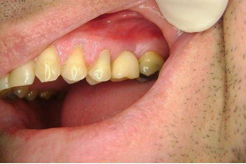 Implante Alvim Cone Morse - Instalação em 20 Minutos, Sem Retalho, Sem Sutura