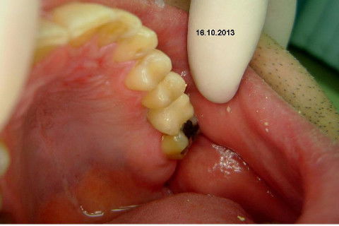 Implante Alvim Cone Morse - Instalação em 20 Minutos, Sem Retalho, Sem Sutura