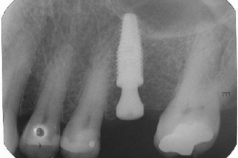 Implante Alvim Cone Morse - Instalação em 20 Minutos, Sem Retalho, Sem Sutura
