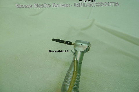 Implante Alvim Cone Morse - Instalação em 20 Minutos, Sem Retalho, Sem Sutura