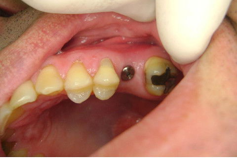 Implante Alvim Cone Morse - Instalação em 20 Minutos, Sem Retalho, Sem Sutura