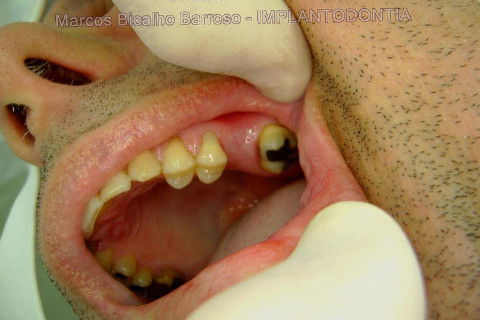 Implante Alvim Cone Morse - Instalação em 20 Minutos, Sem Retalho, Sem Sutura