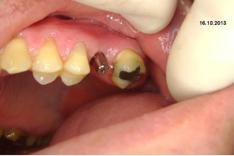Implante Alvim Cone Morse - Instalação em 20 Minutos, Sem Retalho, Sem Sutura