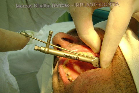 Implante Alvim Cone Morse - Instalação em 20 Minutos, Sem Retalho, Sem Sutura