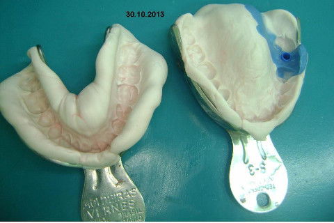 Implante Alvim Cone Morse - Instalação em 20 Minutos, Sem Retalho, Sem Sutura