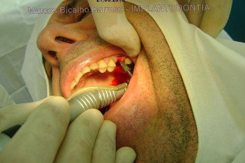 Implante Alvim Cone Morse - Instalação em 20 Minutos, Sem Retalho, Sem Sutura