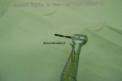 Implante Alvim Cone Morse - Instalação em 20 Minutos, Sem Retalho, Sem Sutura